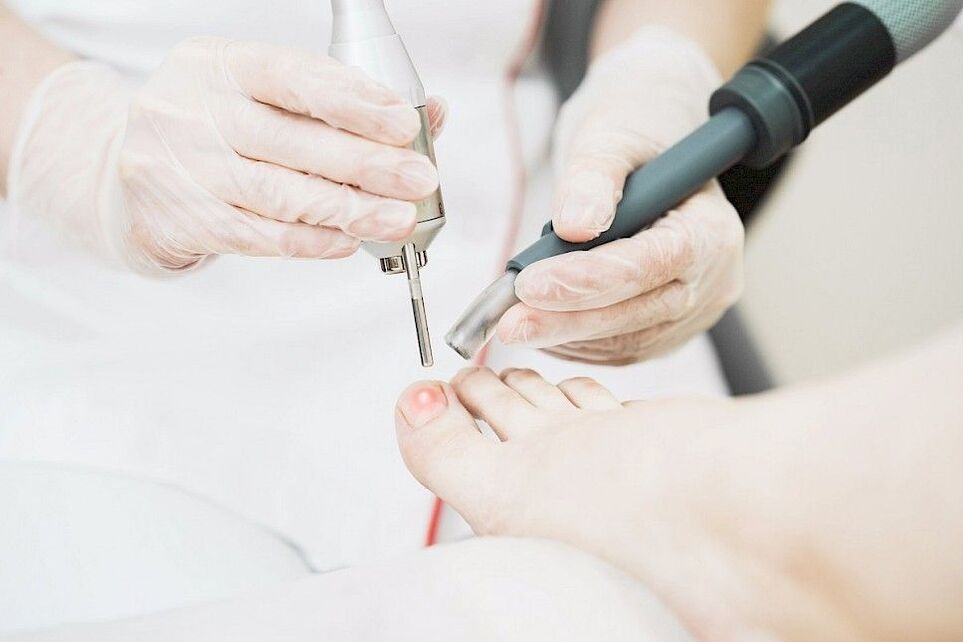 Façons d'éliminer les champignons des pieds. 